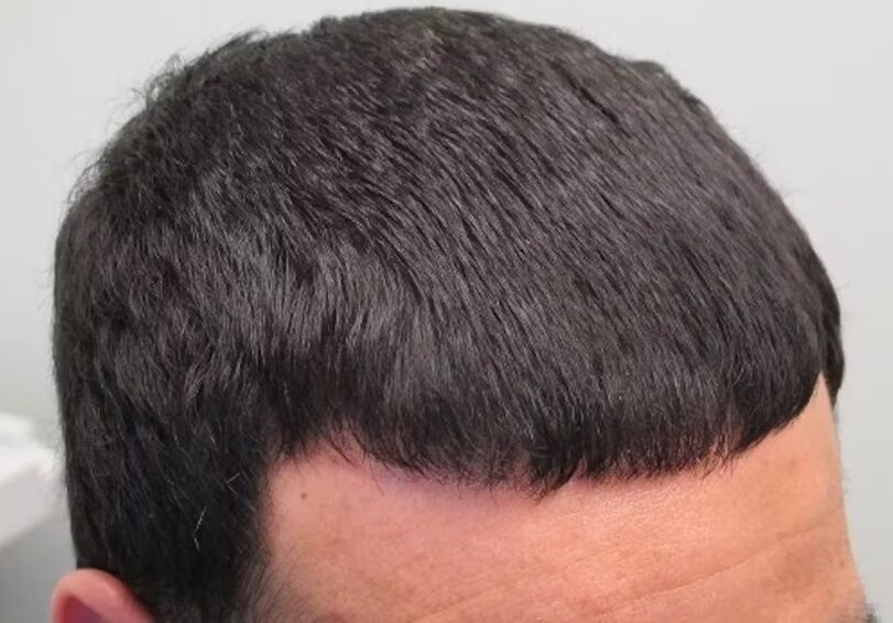 I CUIED VERDOXIDIL HAIR LOSS