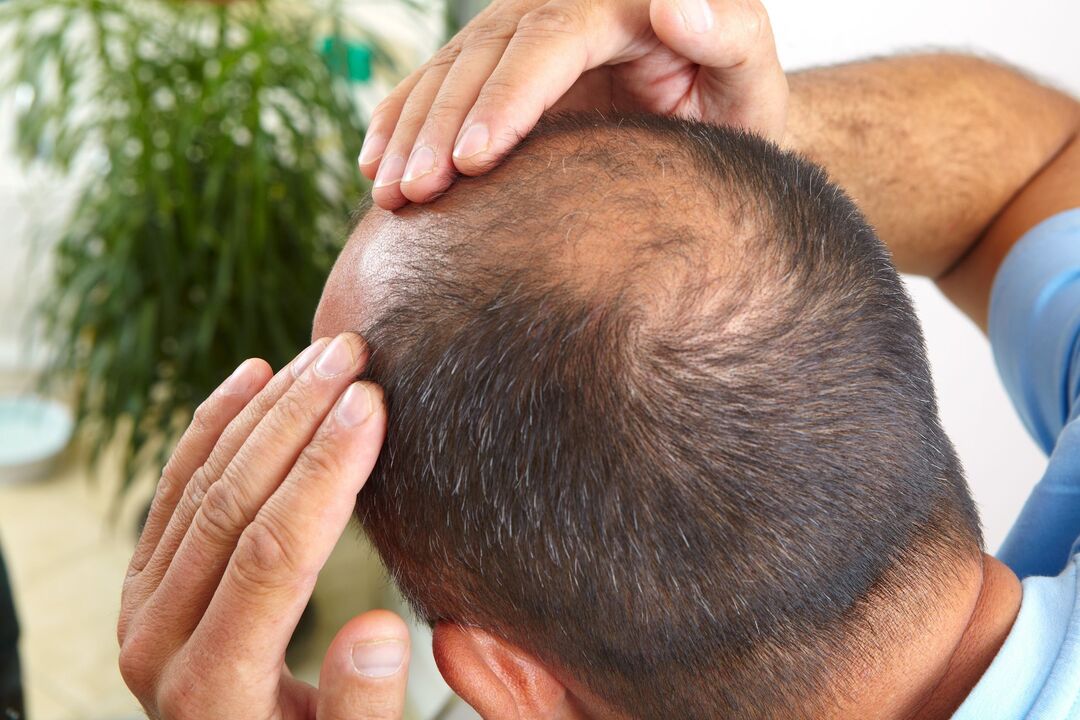 Running the zxcvbnmqwort spray for baldness treatment